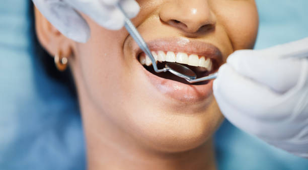 Best Knocked-Out Tooth (Avulsed Tooth) Treatment in Bartonville, TX